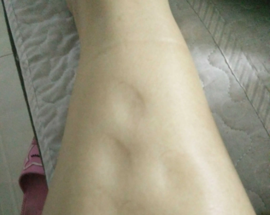 小腿腫脹，一按一個(gè)坑